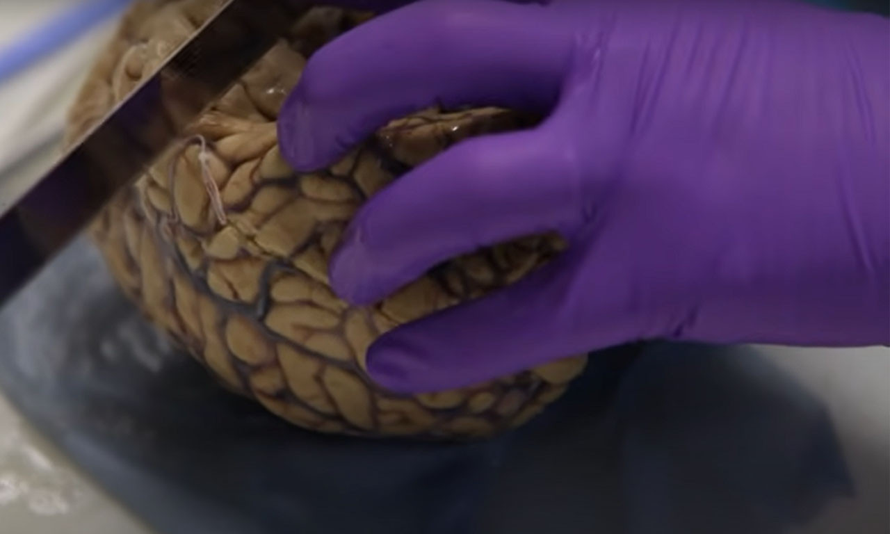 Da li je ovo razlog za PANIKU? Treći SMRTNI SLUČAJ u SAD zbog retke GLJIVIČNE infekcije mozga