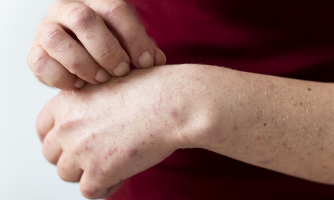 ŠUGA U VRTIĆU I OSNOVNOJ ŠKOLI U UMKI Zaraženo šestoro dece, evo šta kažeu nadležni