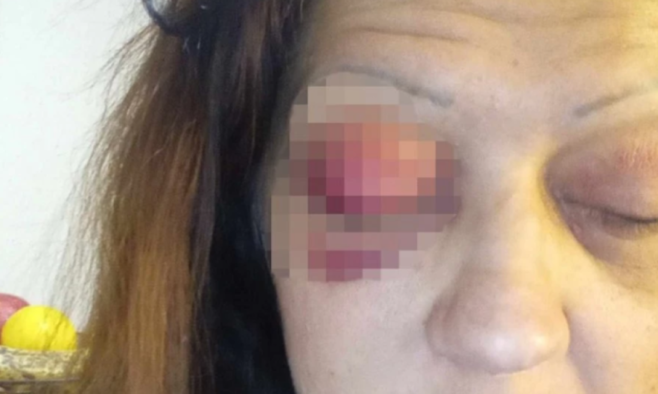 Trovao me, UCENJIVAO I DROGIRAO: Srpsku PEVAČICU PRETUKAO MOMAK, objavila JEZIVE FOTOGRAFIJE