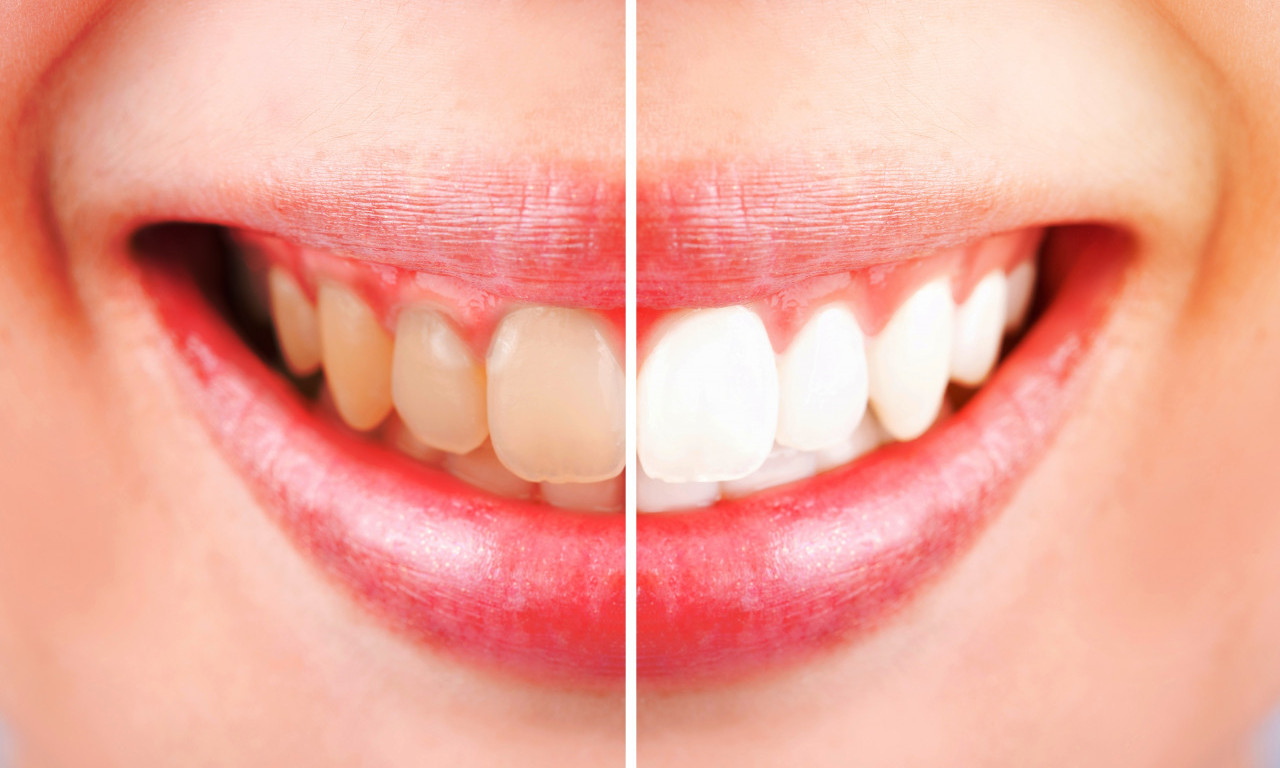 Ove NAMIRNICE izbegavajte ako imate ŽUTE ZUBE! Evo par jednostavnih saveta za BLISTAV osmeh