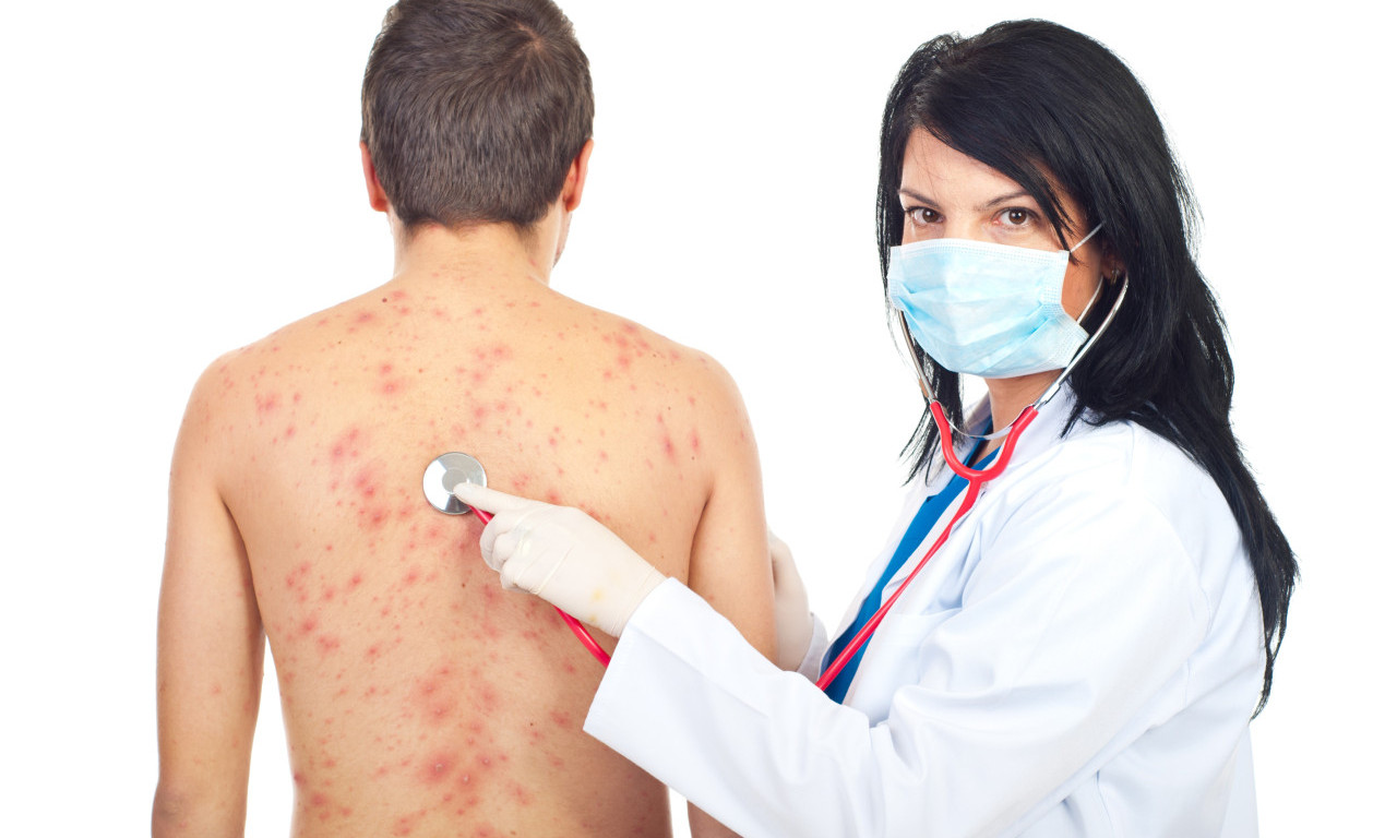 RASTE BROJ OBOLELIH OD MORBILA! Nijedan od troje novozaraženih NIJE VAKCINISAN