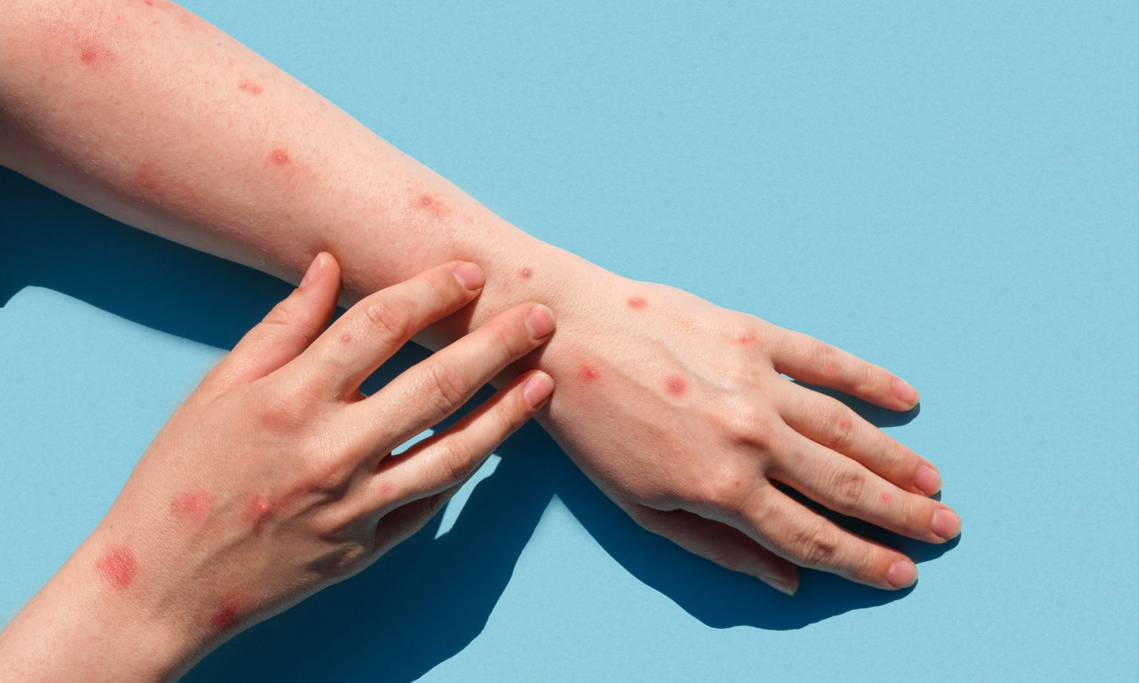 PORASTAO BROJ OBOLELIH OD MALIH BOGINJA! Epidemija se širi, prijavljeno 505 slučajeva