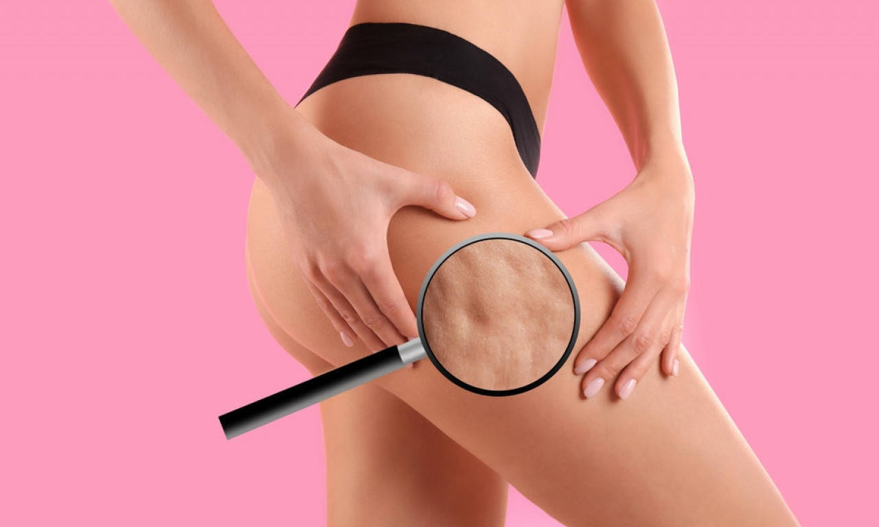 OVO ULJE NAVODNO BRIŠE CELULIT ZA MESEC DANA Da li zaista deluje?