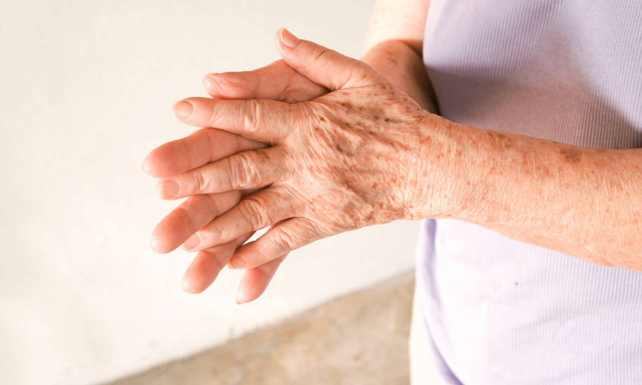 TAMNE MRLJE NA RUKAMA? Evo kako da ih uklonite i vratite rukama mladolik izgled