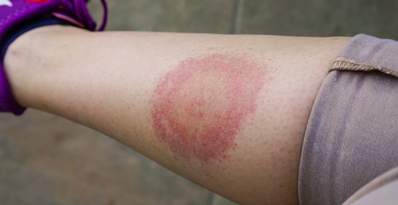 PRETI NOVA SMRTONOSNA EPIDEMIJA "ZEČJA GROZNICA"? Pojavila se opasna bakterija, pogledajte kako se prenosi