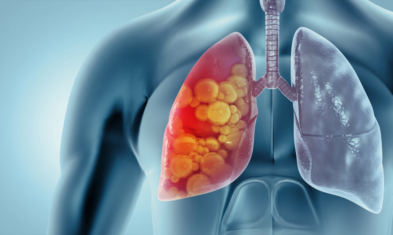 TINEJDŽERKA OBOLELA OD OPASNE BOLESTI ZBOG VEJPA Da li znate šta su to "kokičasta pluća"? (VIDEO)