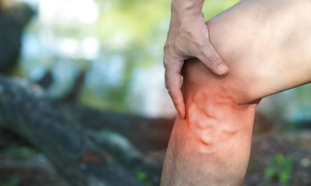 RUSKI RECEPTI ZA UMORNE VENE Domaće, provereno, prirodno!