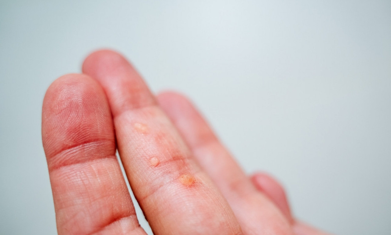 RUSKI LEK ZA UKLANJANJE BRADAVICA Receptura koja se prenosi s kolena na koleno!