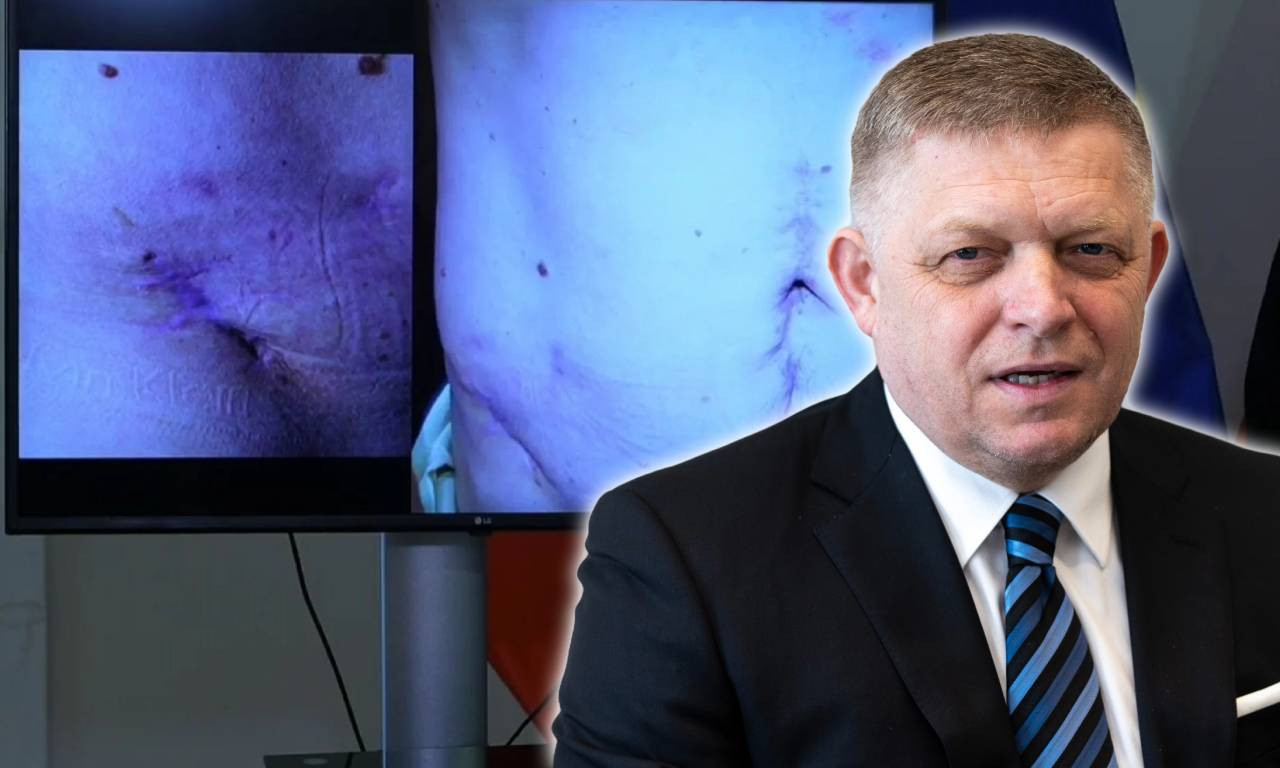 FICO POKAZAO ISKASAPLJEN STOMAK OD ATENTATA Pogledajte kroz kakav linč je prošao premijer Slovačke (FOTO)