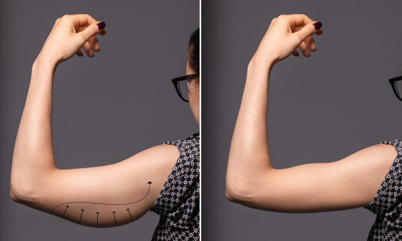 REŠITE SE MLOHAVIH NADLAKTICA Tri koraka do čvrstih i lepih ruku!