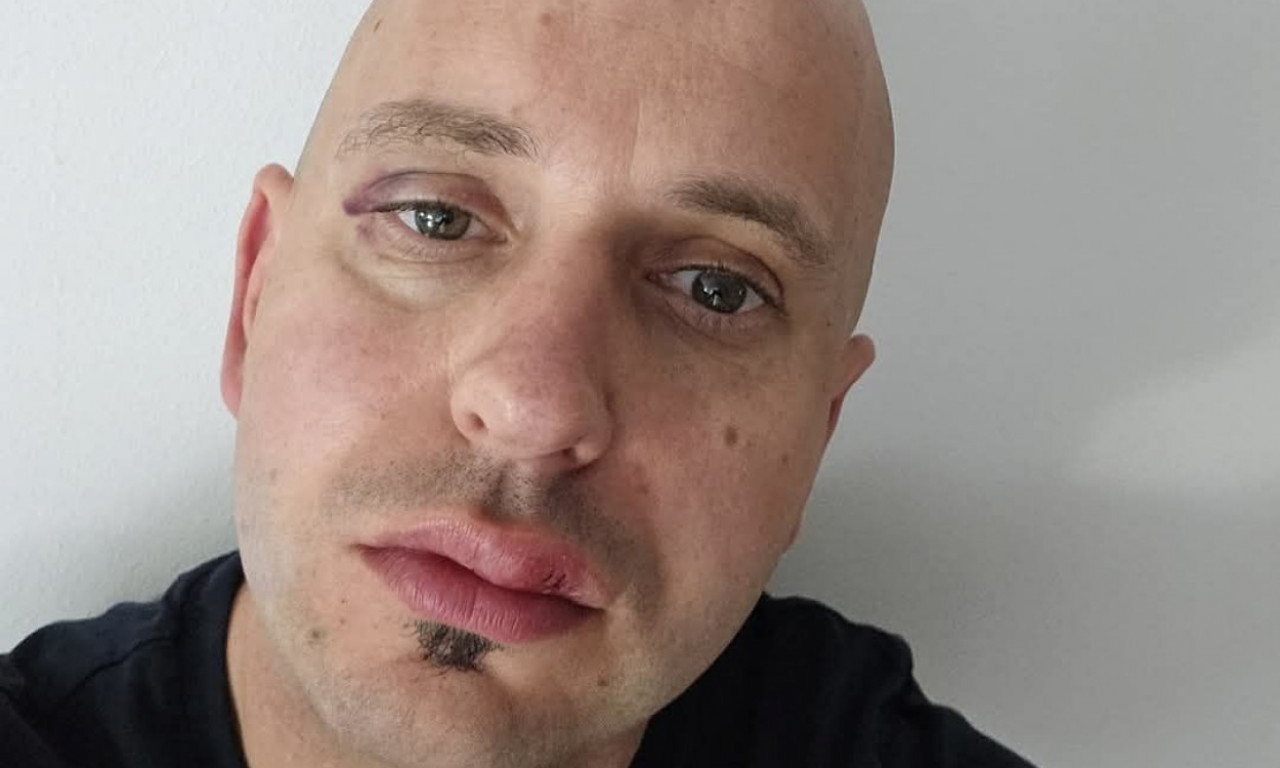 PRETUČEN GRADONAČELNIK! Rascepana mu usna i slomljen nos! Evo ko ga je tukao (FOTO)