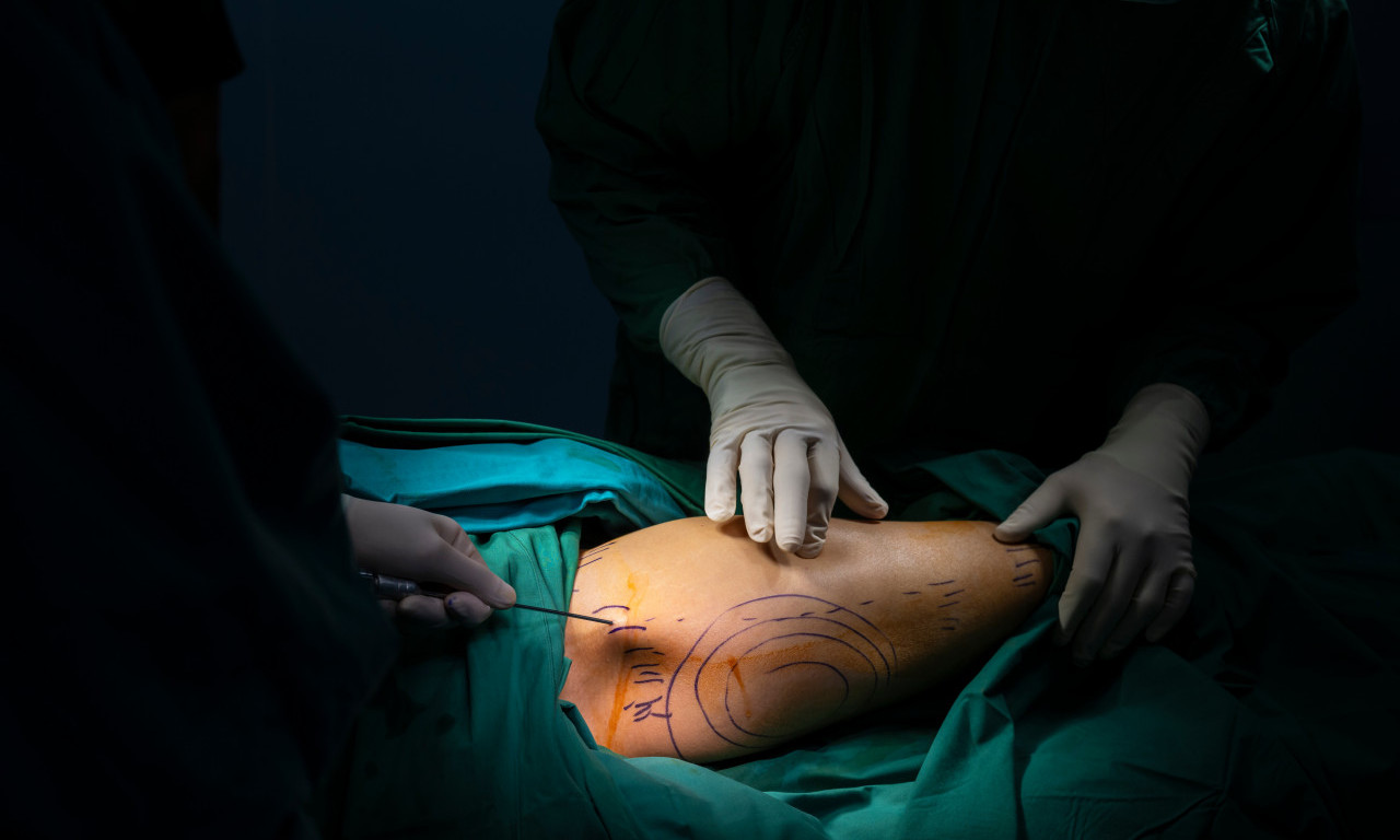 HOROR U ESTETSKOJ MEDICINI Žena preminula tokom liposukcije, 14 ilegalnih klinika zatvoreno!