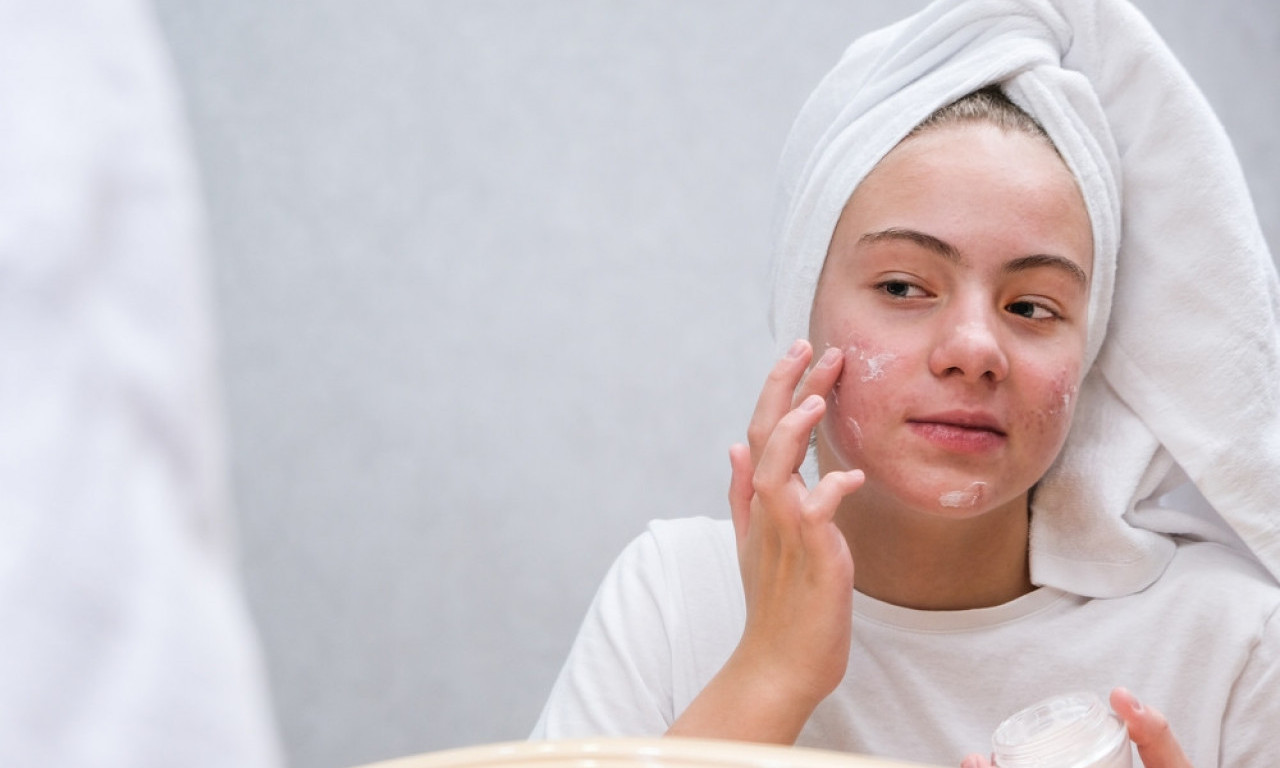 MAŽU SE, A POSLE PLAČU Tinejdžerke zbog TikToka rizikuju doživotne alergije!