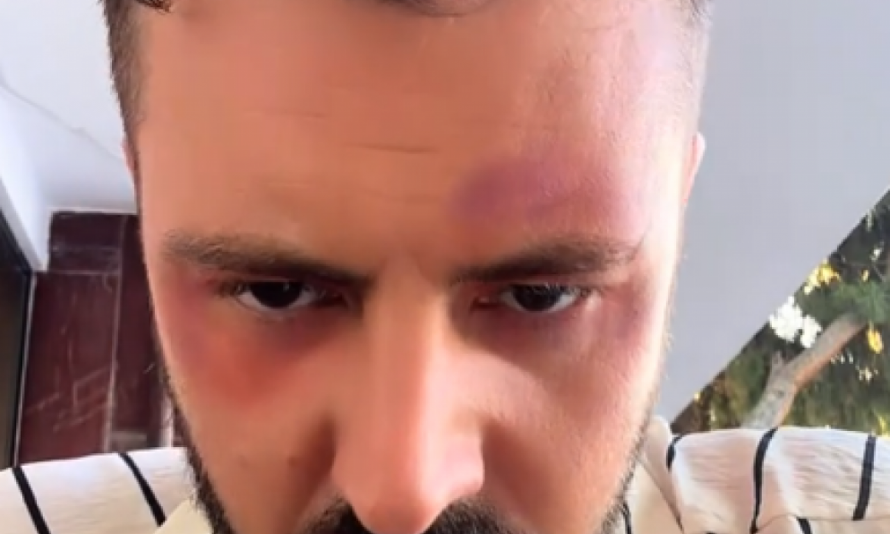 PEVAČ PRETUČEN U TURSKOJ Goran pokazao lice u podlivima! (UZNEMIRUJUĆI VIDEO)