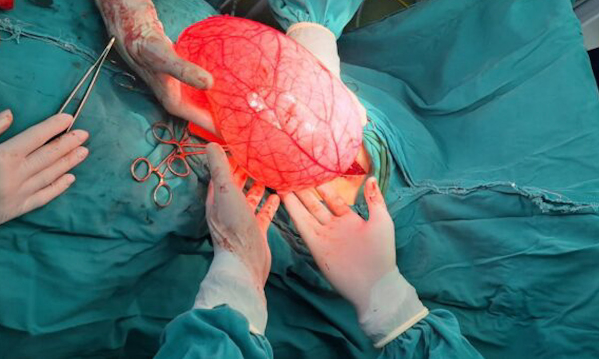 DEVOJČICA IZ VALJEVA (15) BILA NA DIJETI, A STOMAK RASTAO Pogledajte šta su joj lekari uklonili iz trbuha (FOTO)