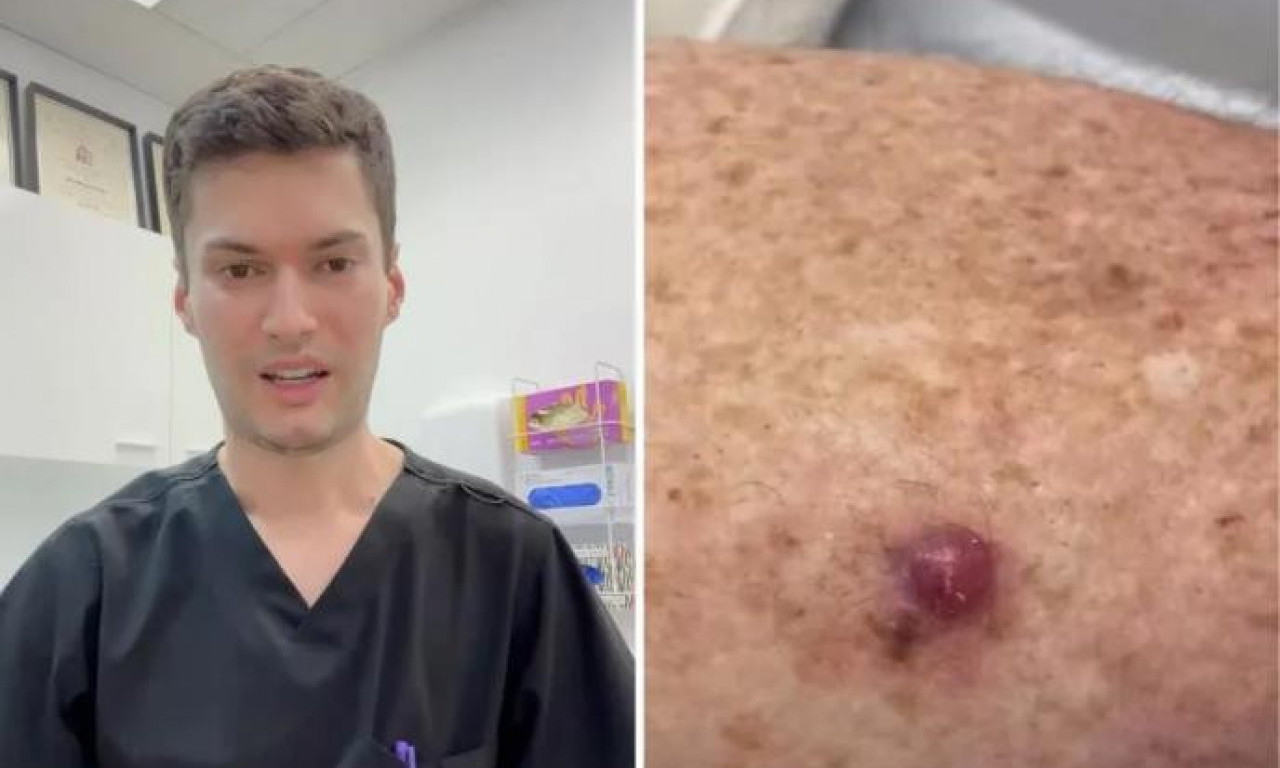AKO OVO PRIMETITE NA KOŽI ODMAH SE JAVITE LEKARU: Doktor upozorio na strašan slučaj raka