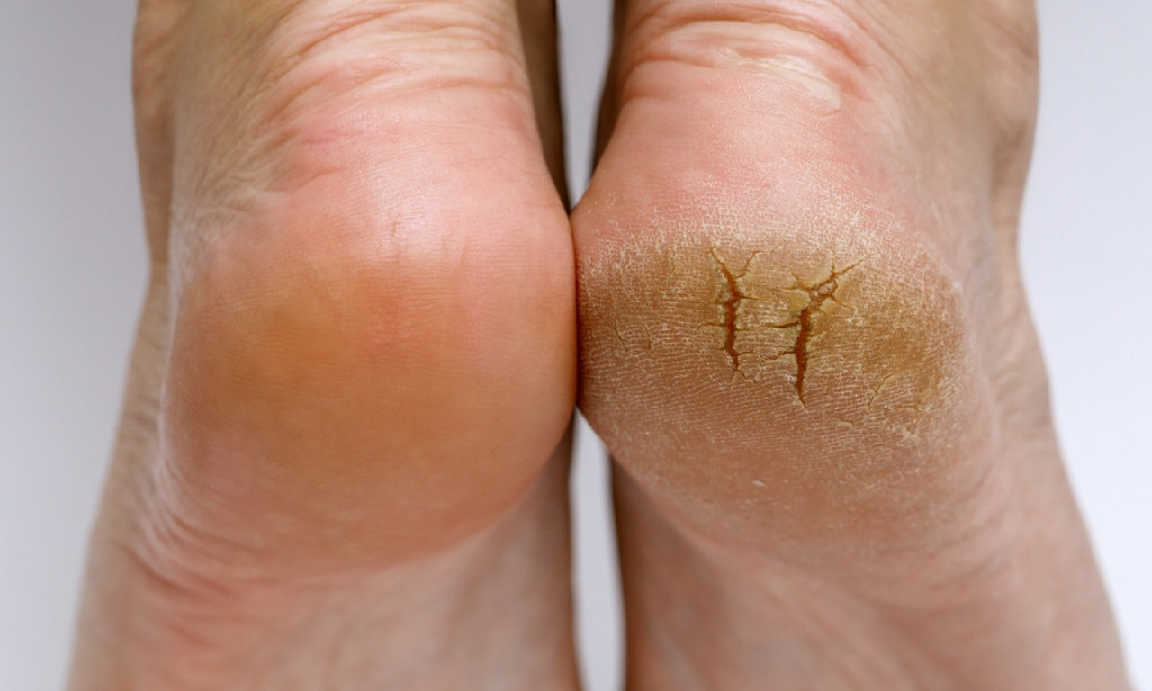 DOMAĆA KREMA ZA SUVE PETE I TVRDU KOŽU Jednostavan recept sa vazelinom, kokosovim uljem i jednim tajnim sastojkom!