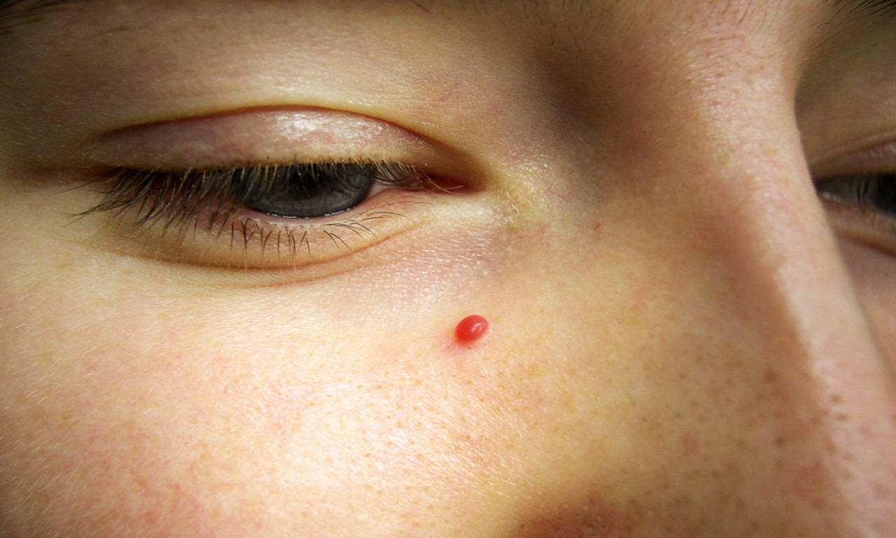 DA FIBROMI I BRADAVICE NESTANU Evo kako ih možete ukloniti prirodno, kod kuće i bez muke!