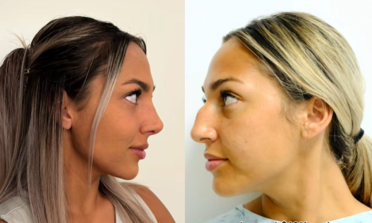 NOVI NOS ZA 4.700 EVRA Amerikanke sve više putuju u Tursku na korekcije (FOTO)