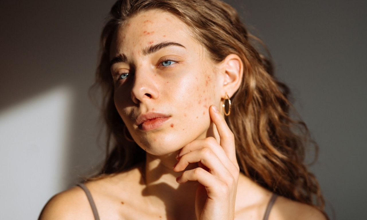 NAPRAVITE SAMI Domaća krema za ožiljke koja zaista deluje!