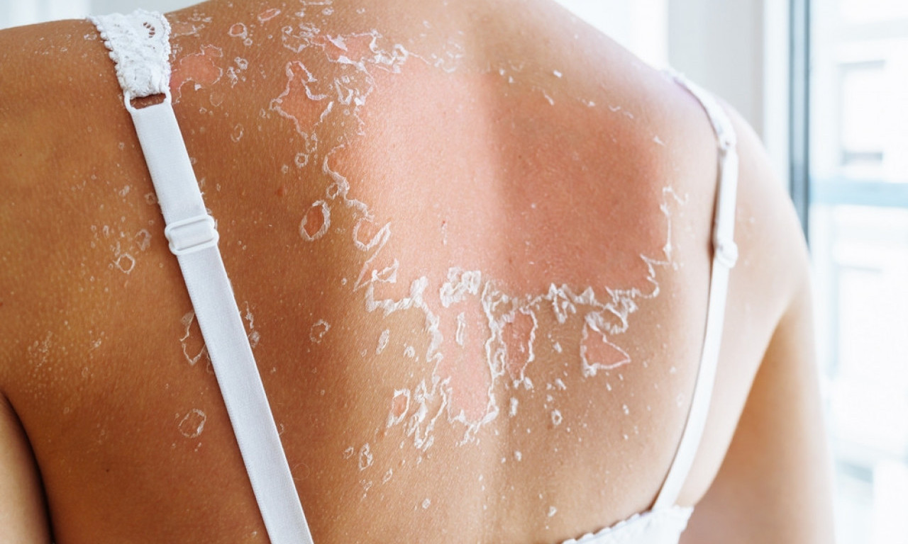 IZGORELI STE NA SUNCU? Evo što nikako ne smete da radite kada koža počne da se ljušti, ma koliko god bilo primamljivo