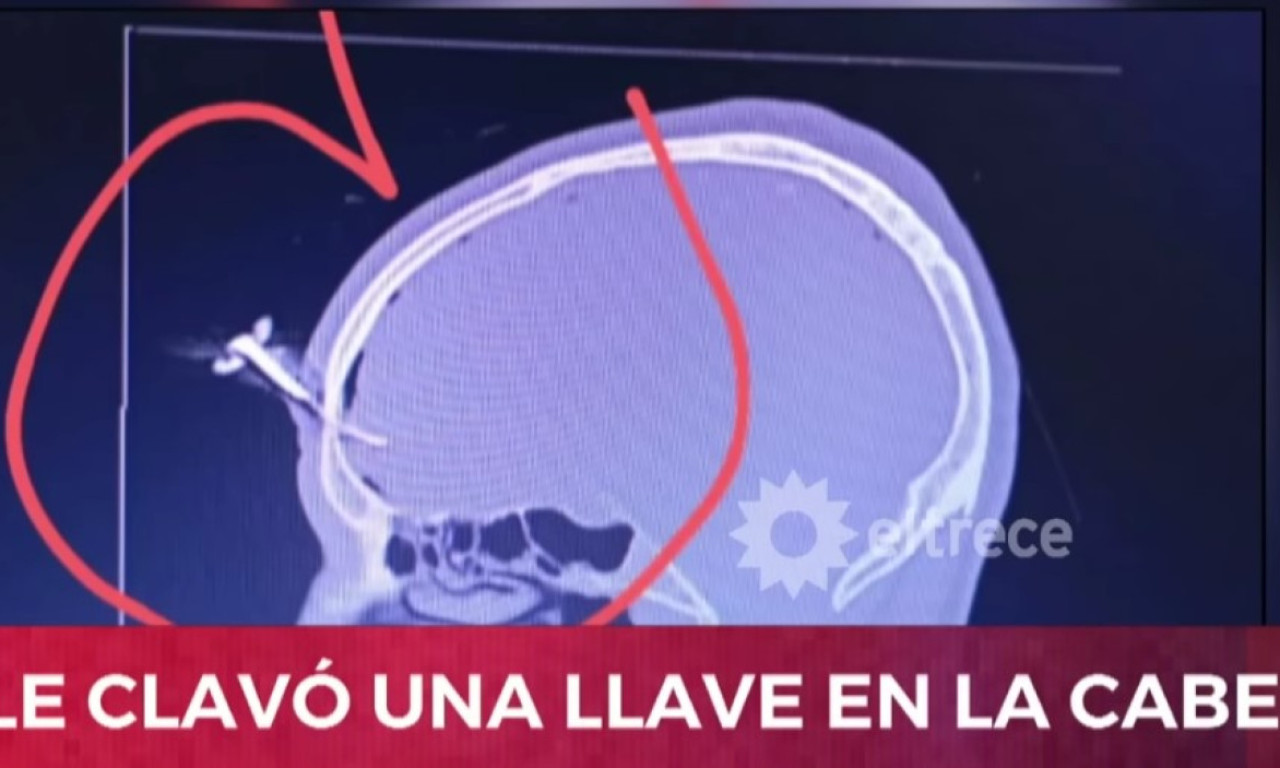 KLJUČ OD AUTA SE ZAGLAVIO U ČELU FUDBALERA Dramatične scene sa terena iz Argentine (FOTO + VIDEO)
