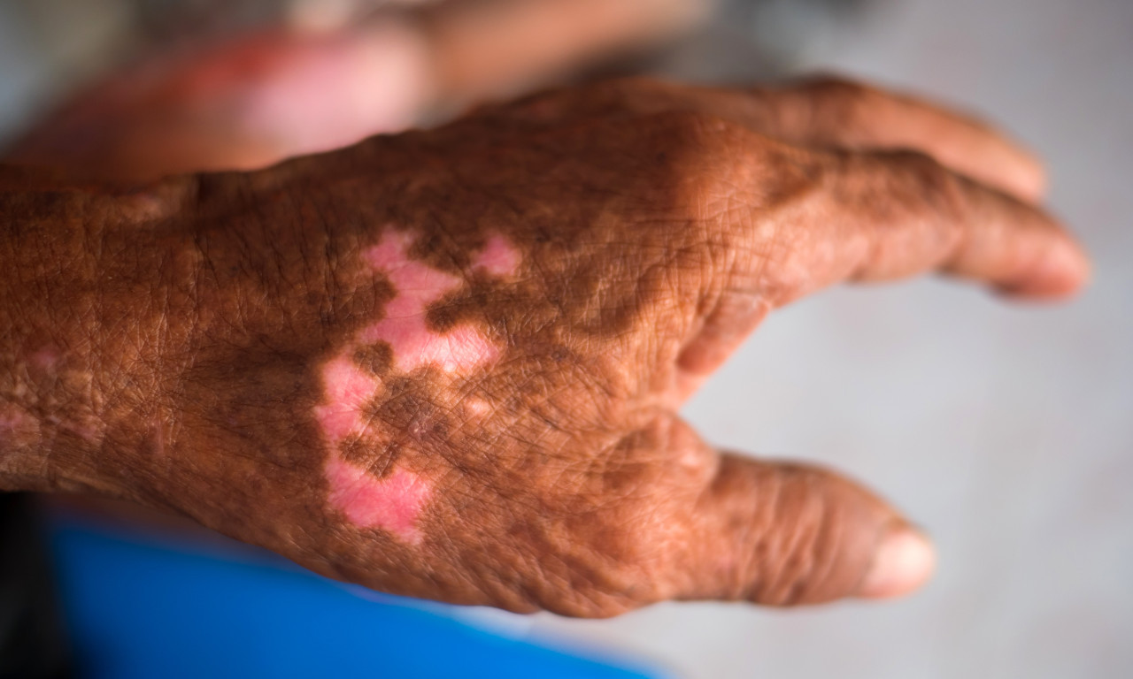 LEPRA STIŽE IZ KOMŠILUKA? ALARM U REGIONU, BATUT HITNO REAGOVAO: Evo istine o opasnoj bolesti (VIDEO)