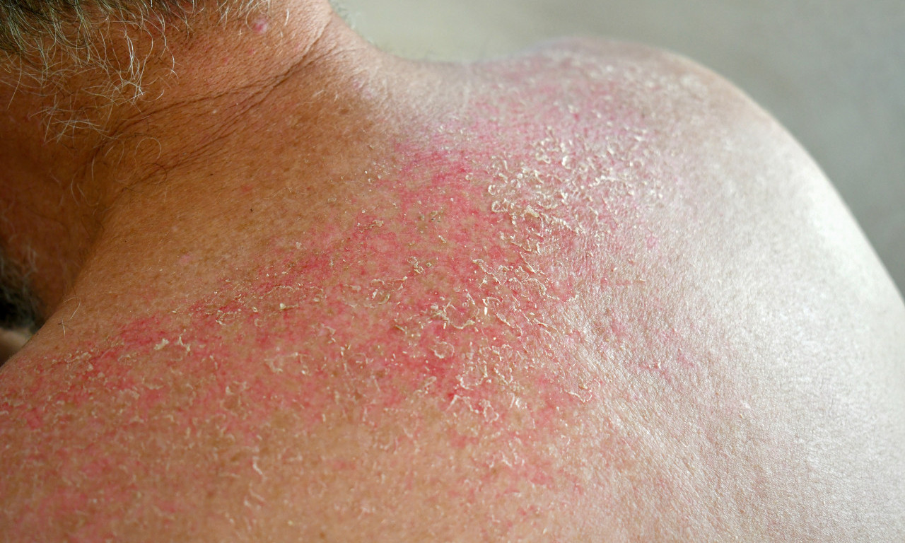 TEŠKA ZARAZNA BOLEST HARA KOMŠILUKOM, SRBI U PANICI: Šta je lepra, kako se prenosi i da li postoji razlog za strah?