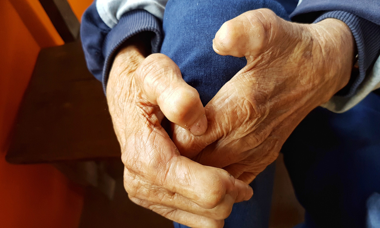 ZBOG LEPRE HITNO HOSPITALIZOVANE JOŠ DVE OSOBE: Zaražene radnice SPA centra