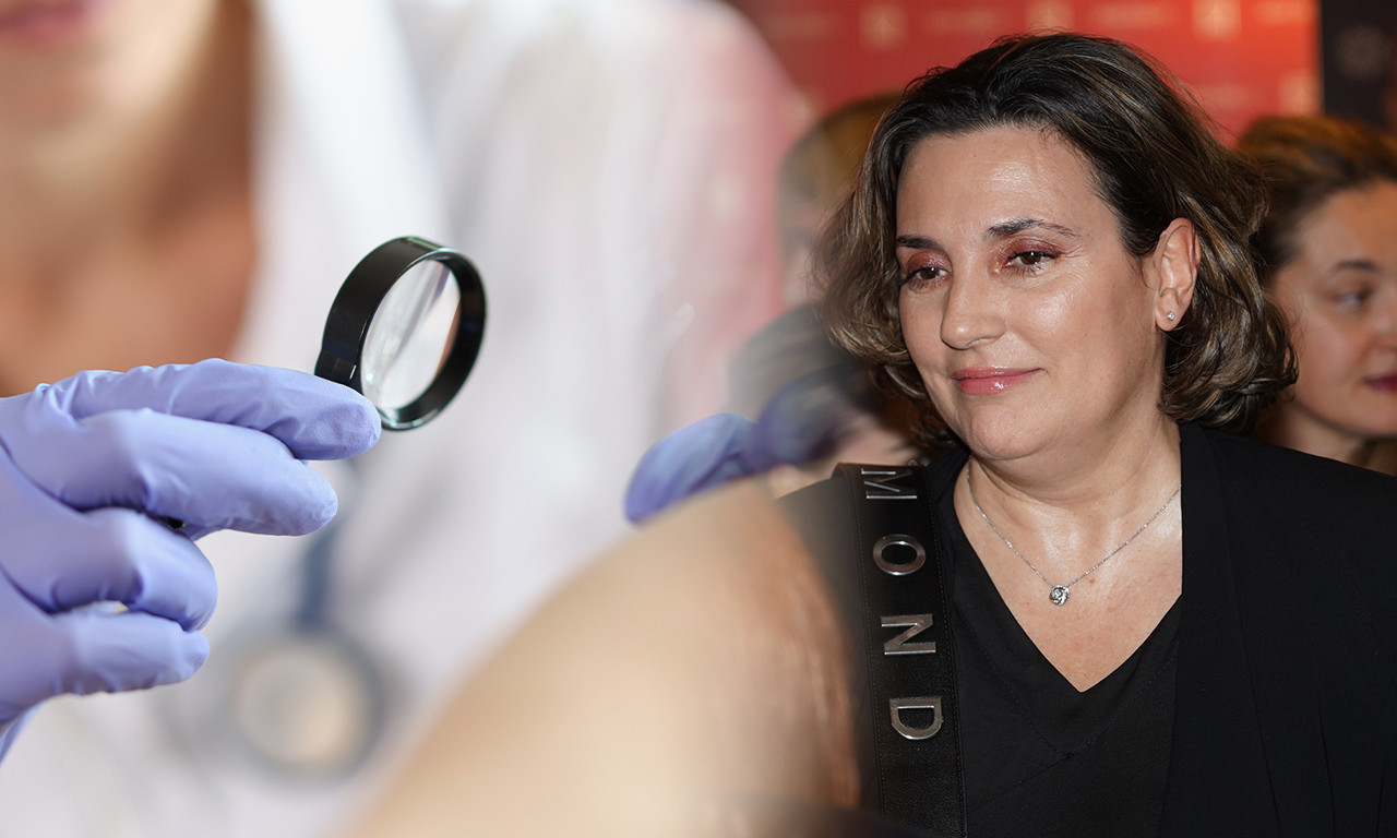 OVAJ TUMOR JE OTKRIVEN MILICI MILŠI Evo šta je basocelularni karcinom kože i kako se leči