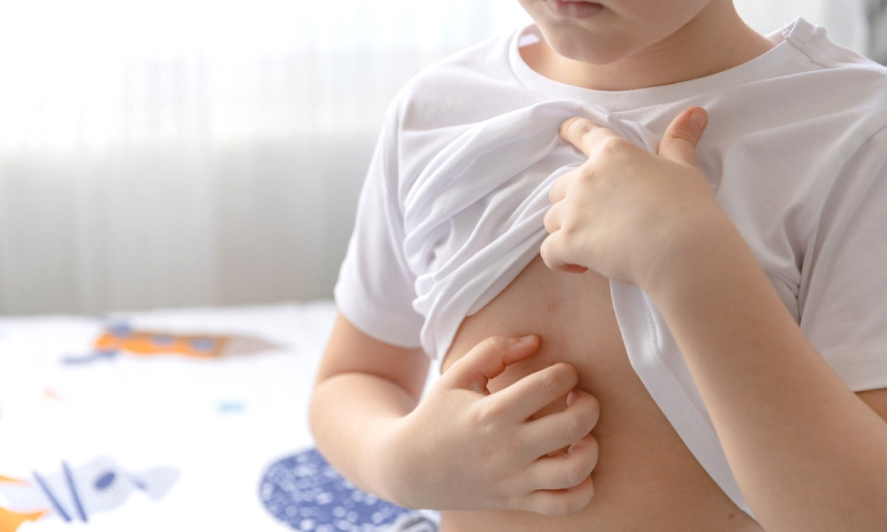 AKO PRIMETITE OVO, CELA PORODICA MORA NA LEČENJE! Ovo su ključni simptomi šuge i kako se prenosi (VIDEO)