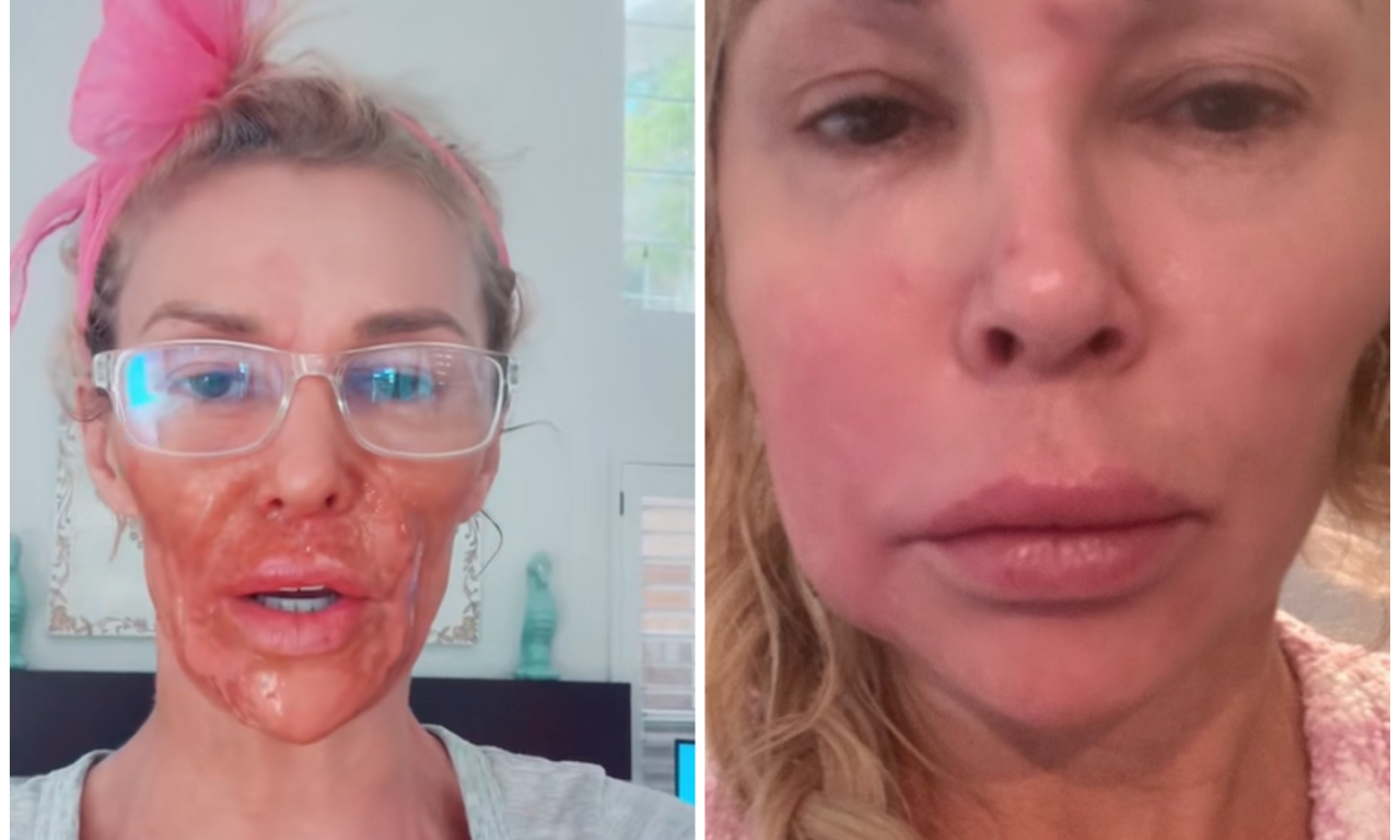 SILIKONI JOJ POJELI LICE! Jeziva ispovest rijaliti zvezde: „Implantati su pukli, otrov mi je ušao u limfu i unakazio me – ostala sam i bez zuba!“