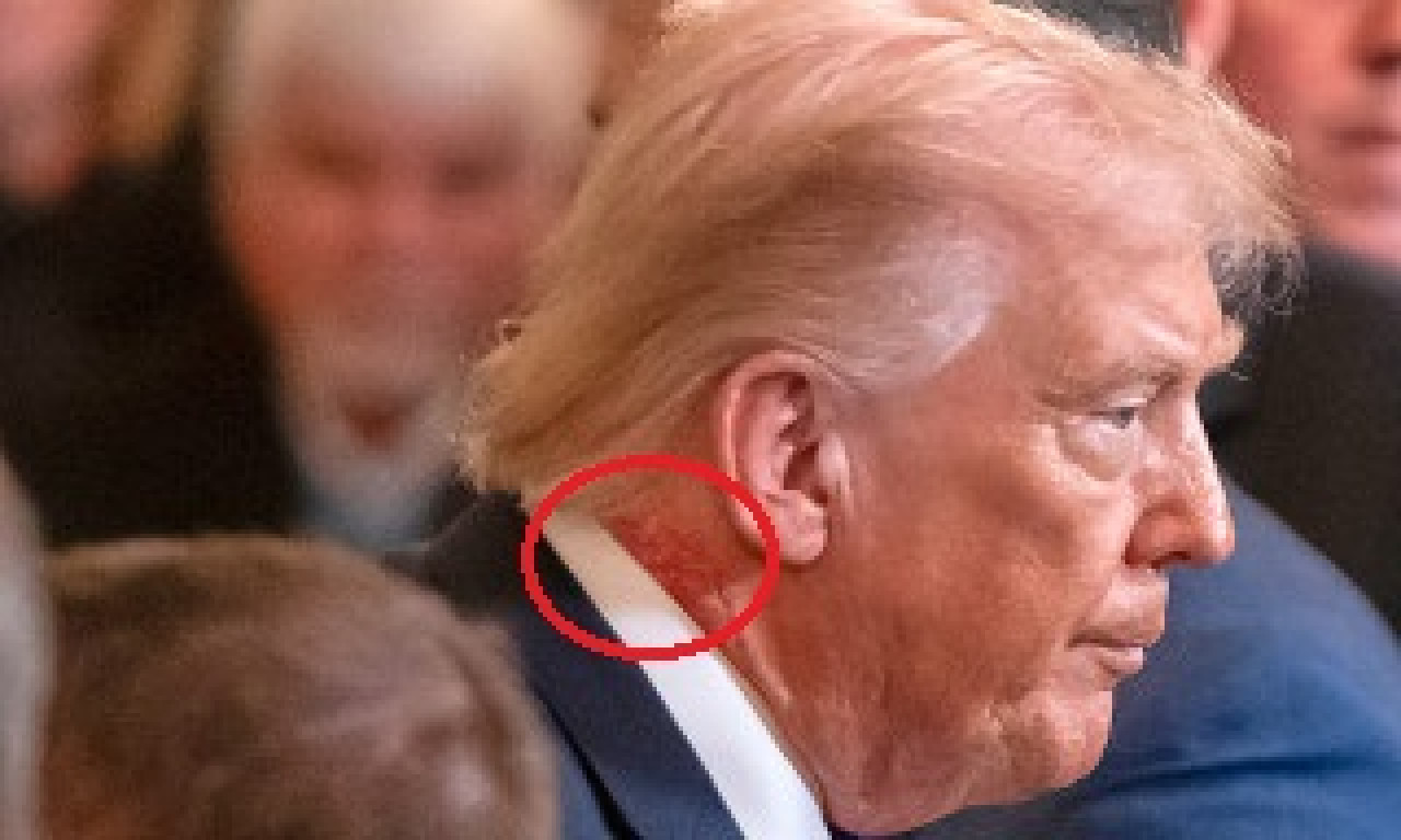 TRAMP NA TERAPIJI U JEKU NAPADA NA IRAN Ceo svet gleda u mrlju na njegovom vratu, oglasili se lekari (FOTO)