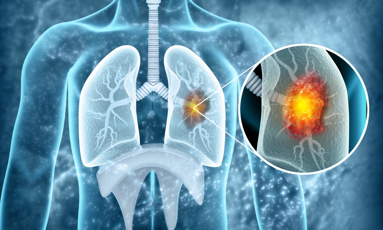 KAKO SE LEČI RAK PLUĆA U SRBIJI?! Dijagnostika je brža nego ikad, ali jedna stvar predstavlja najveći problem