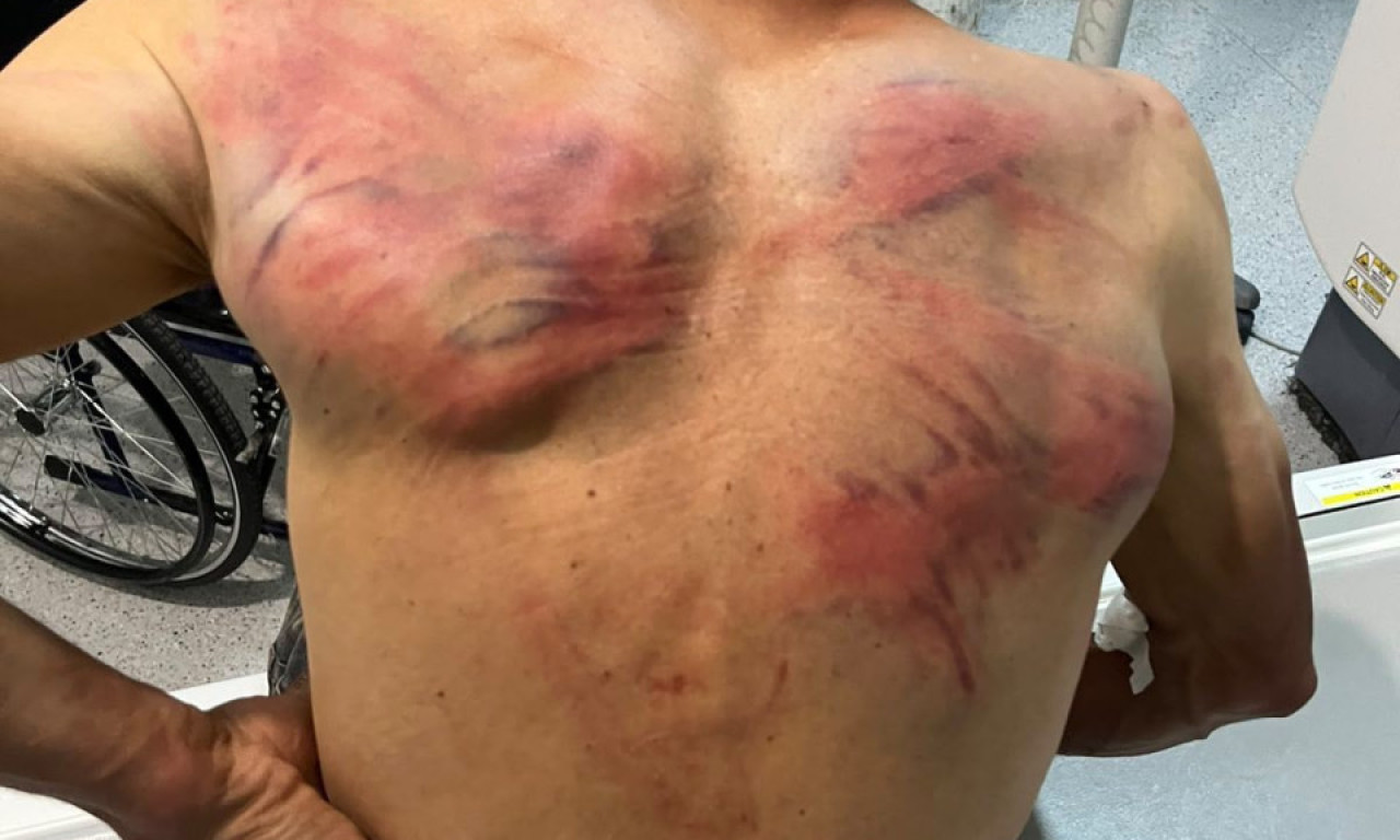 JEZIVO NASILJE NAD SRBINOM NA KOSOVU I METOHIJI, OGLASILA SE SRPSKA LISTA: Zverski pretučen Nenad Rašković, tzv. kosovska policija mu lomila rebra crevom! (FOTO/VIDEO)